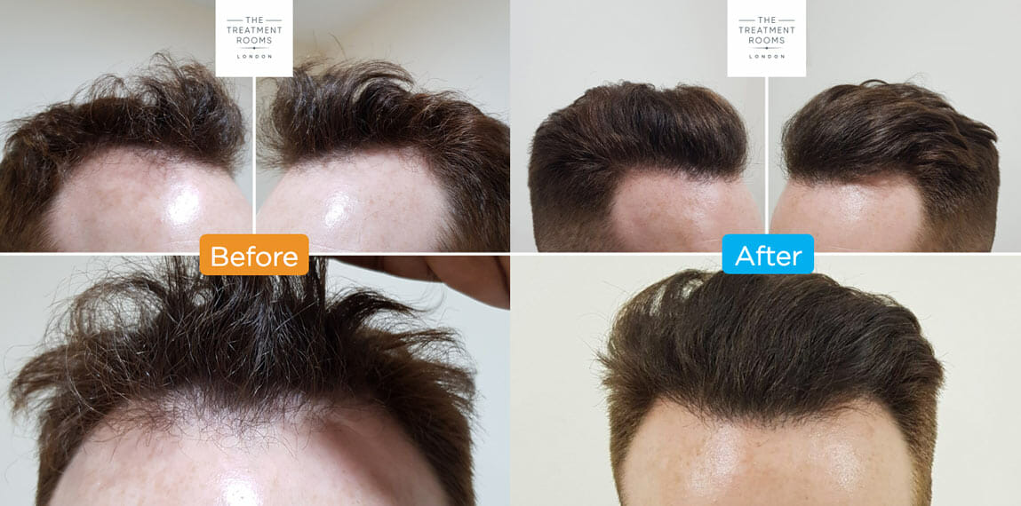 front and temporal FUE hair transplant london