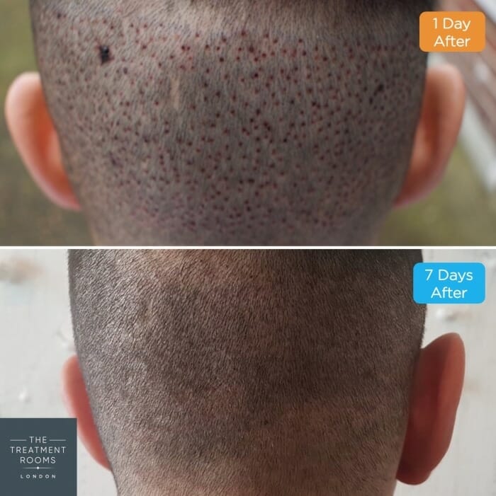 Before-and-After Hair Transplant recovery
