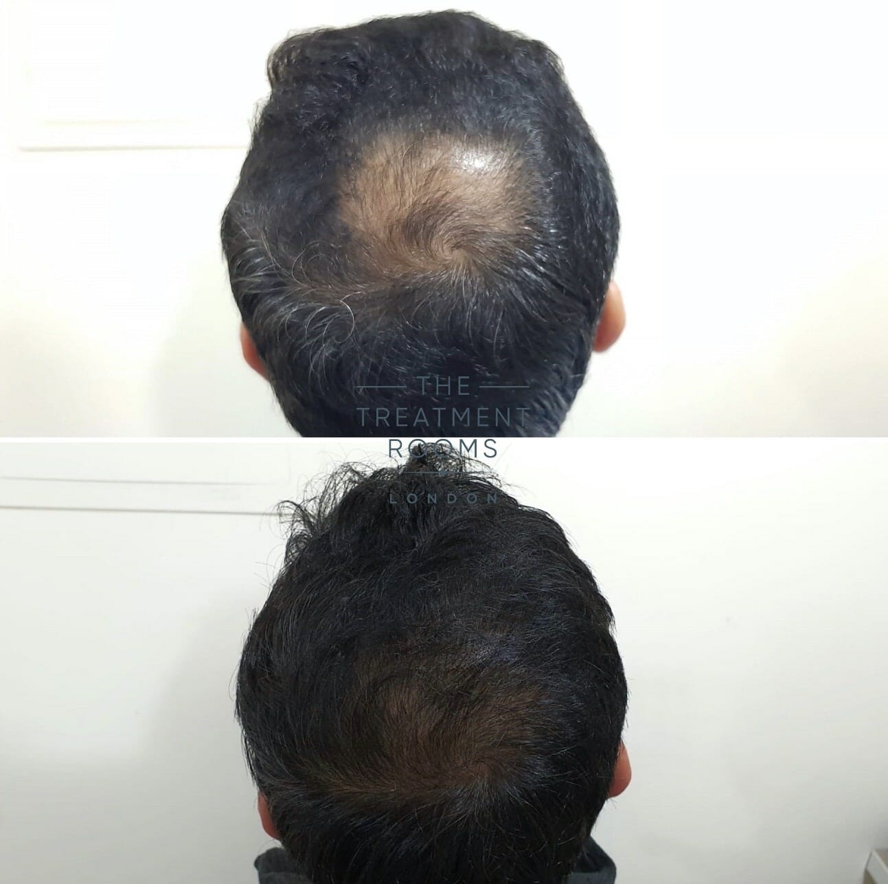 crown hair transplant before and after 997 grafts