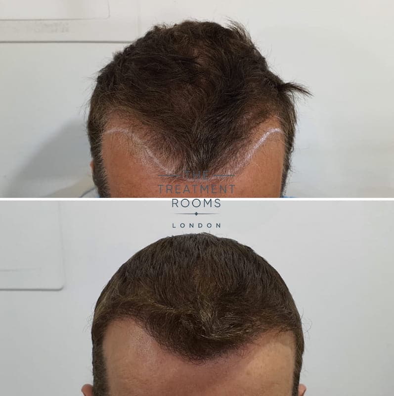 Before and after FUE hair transplant hairline 1452 grafts