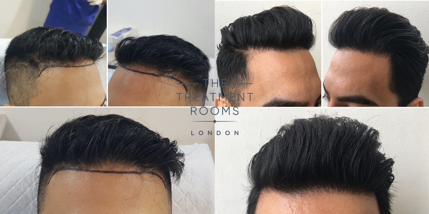 Before and after FUE hair transplant in London clinic