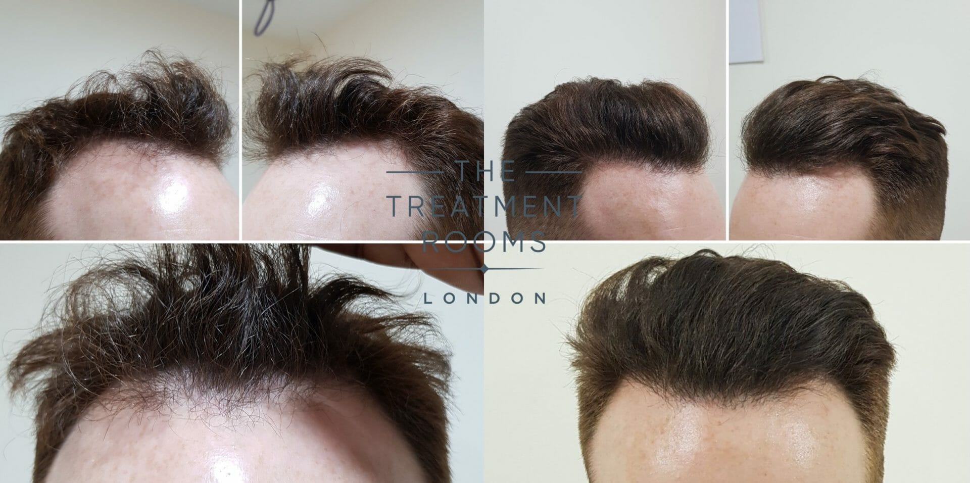 Before and after FUE hair transplant patient result