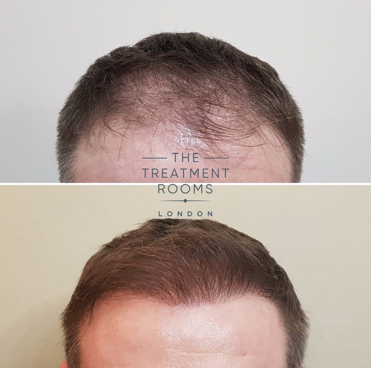 hairline FUE hair transplant result 1286 grafts