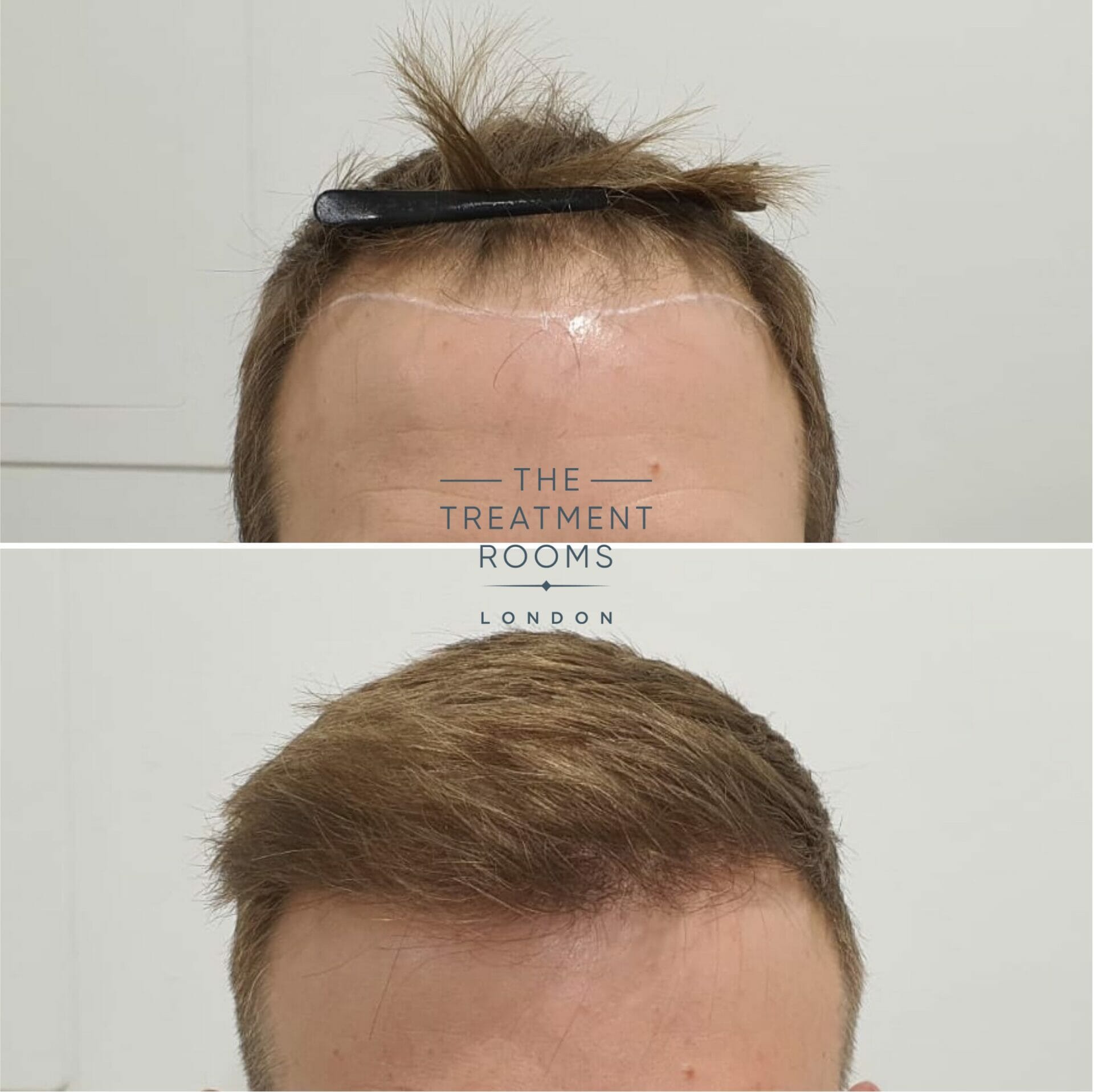 Before and after FUE hair transplant
