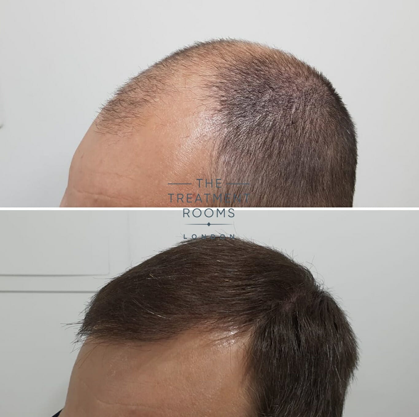 Before and after hair transplant