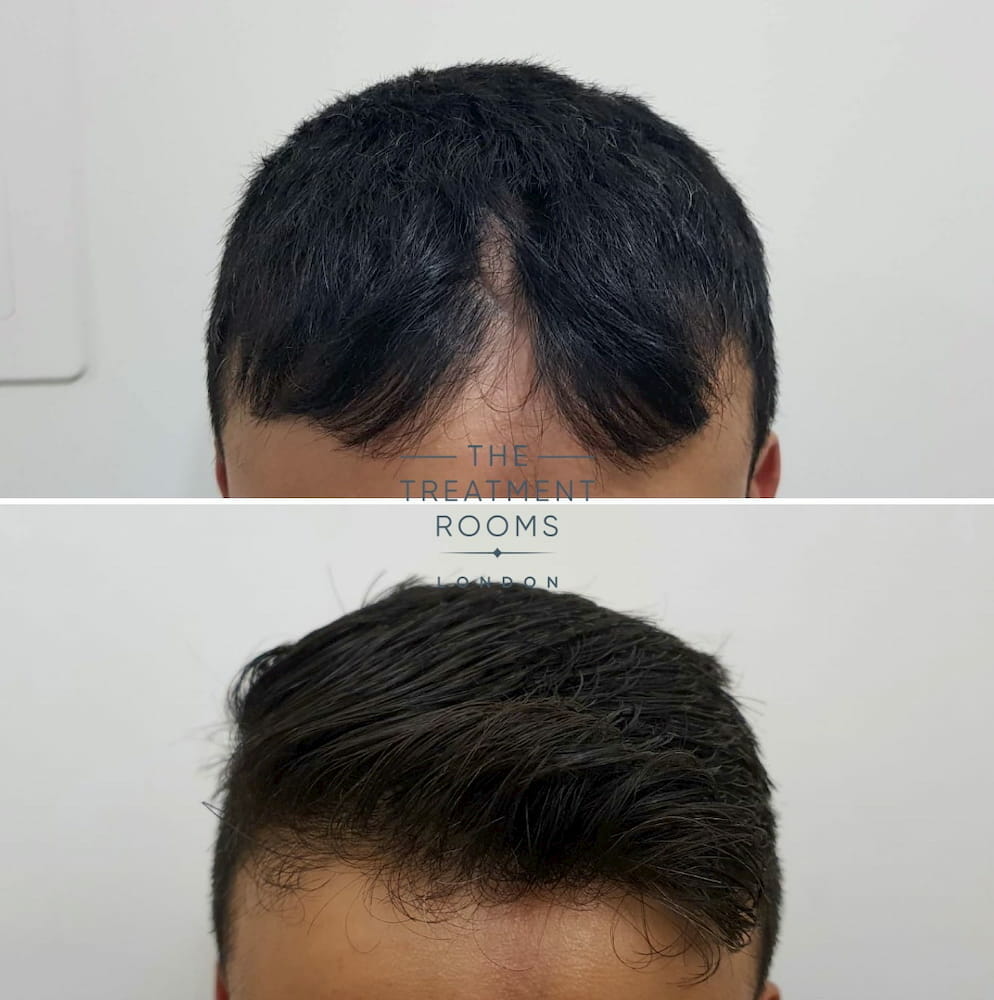 hair transplant linear scleroderma scar