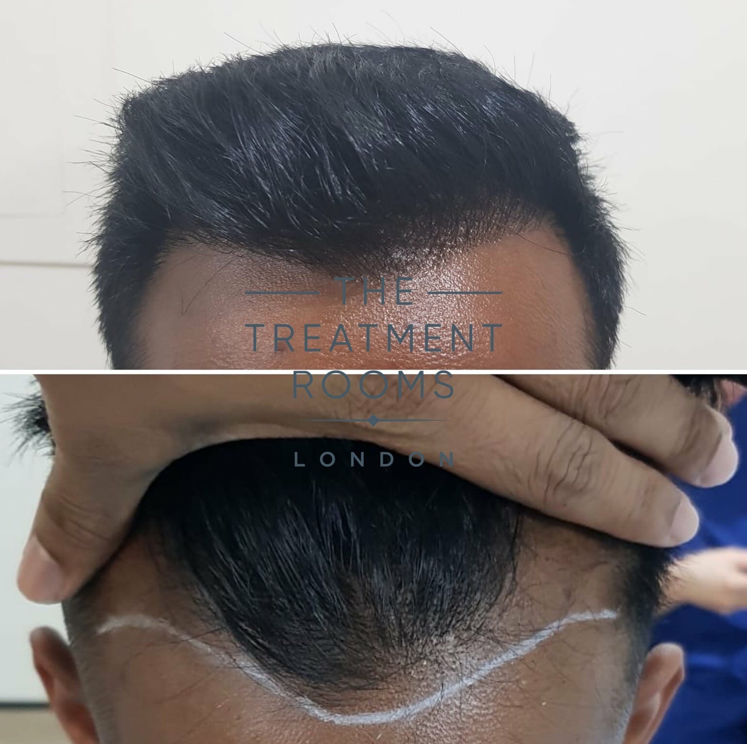Hairline Hair transplant the treatment rooms london