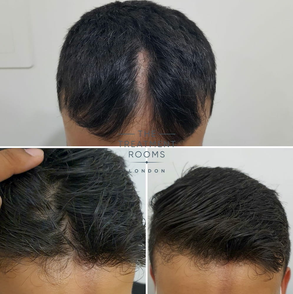 Before and after hair transplant for linear scleroderma