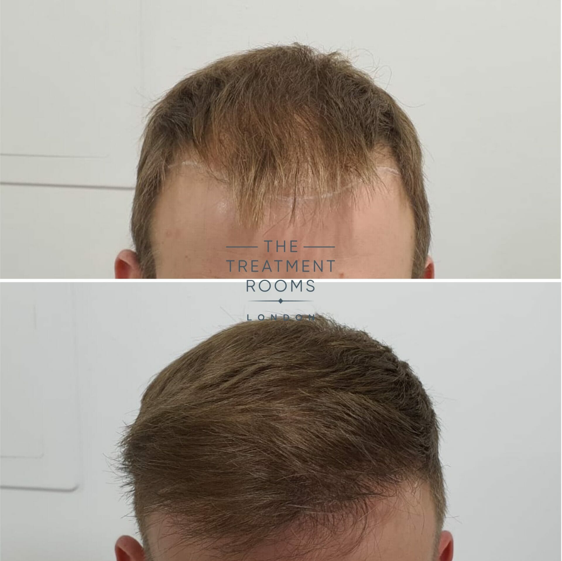 Before and after hairline FUE hair transplant