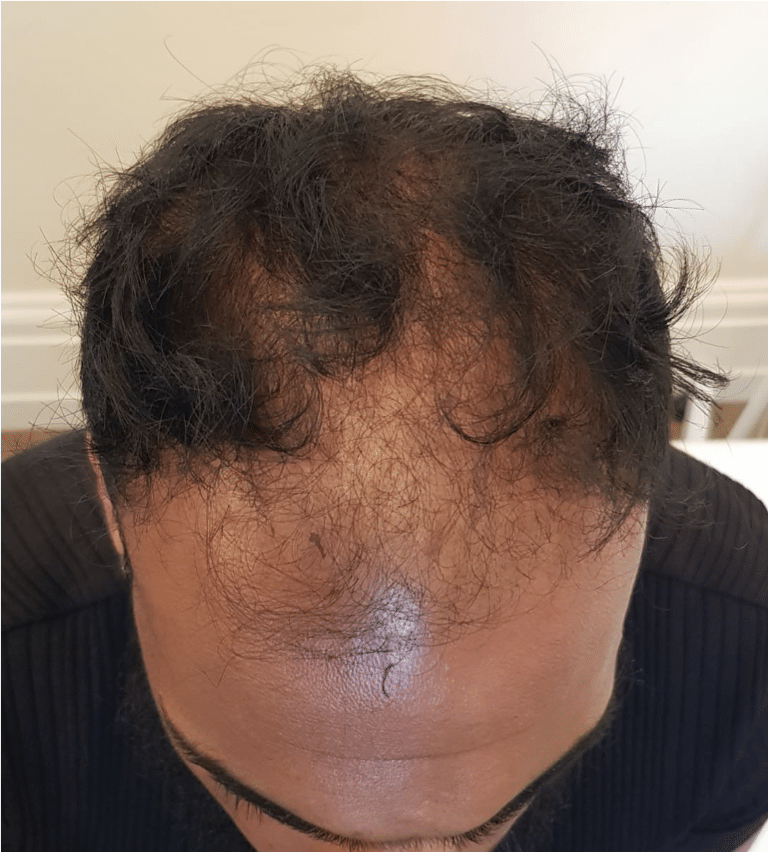 Before hair transplant Before hair transplant