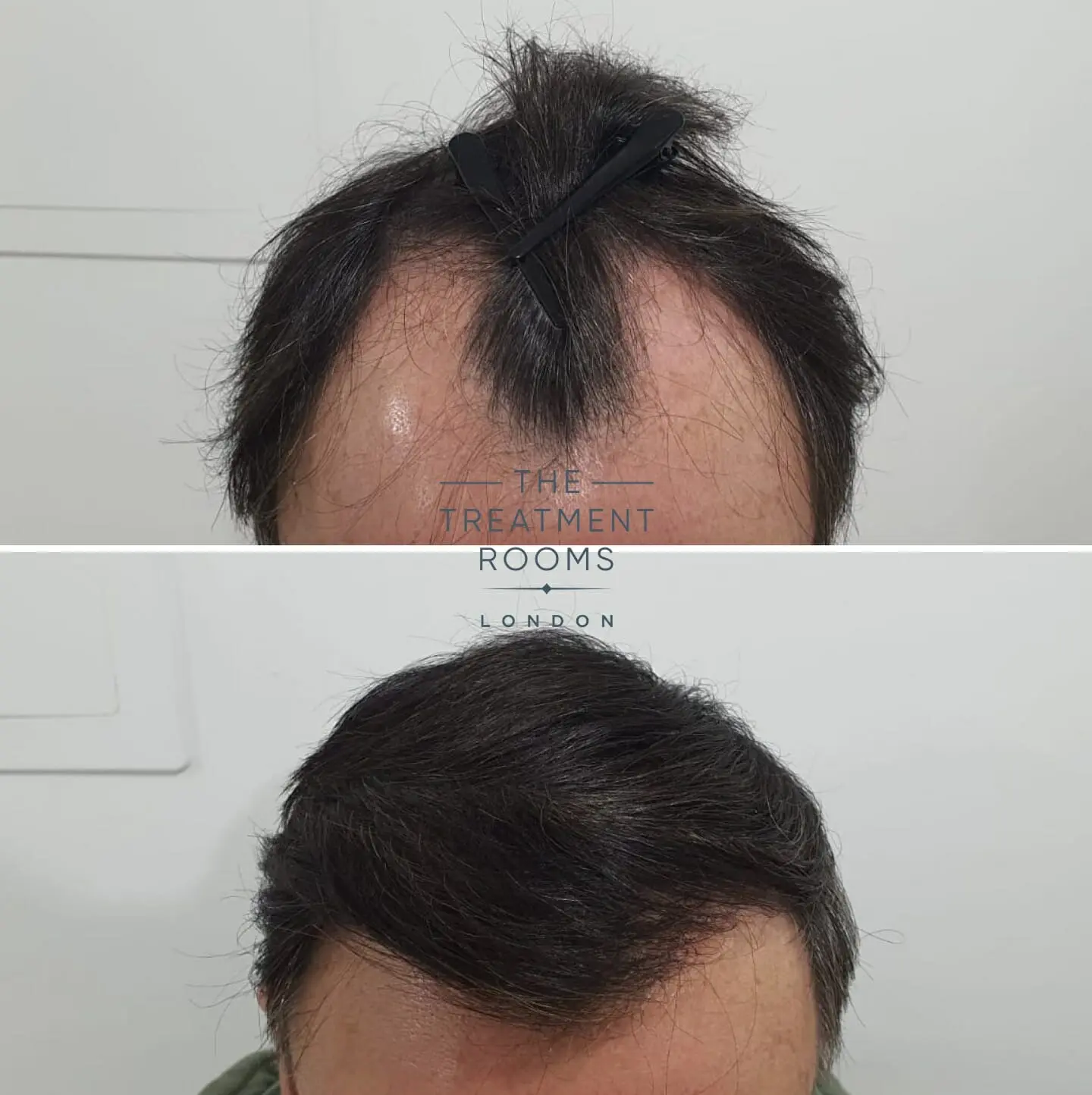 Grade 3 Baldness Results  2000 FUEDHT grafts and a 7months update at  Eugenix Hair Sciences India  YouTube