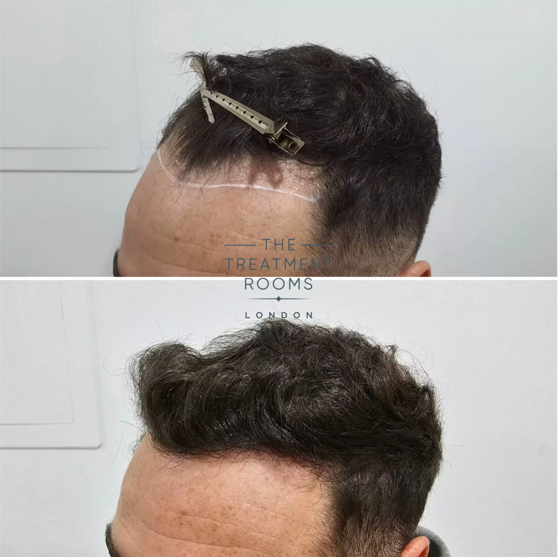Best hairline hair transplant 1303 grafts before and after