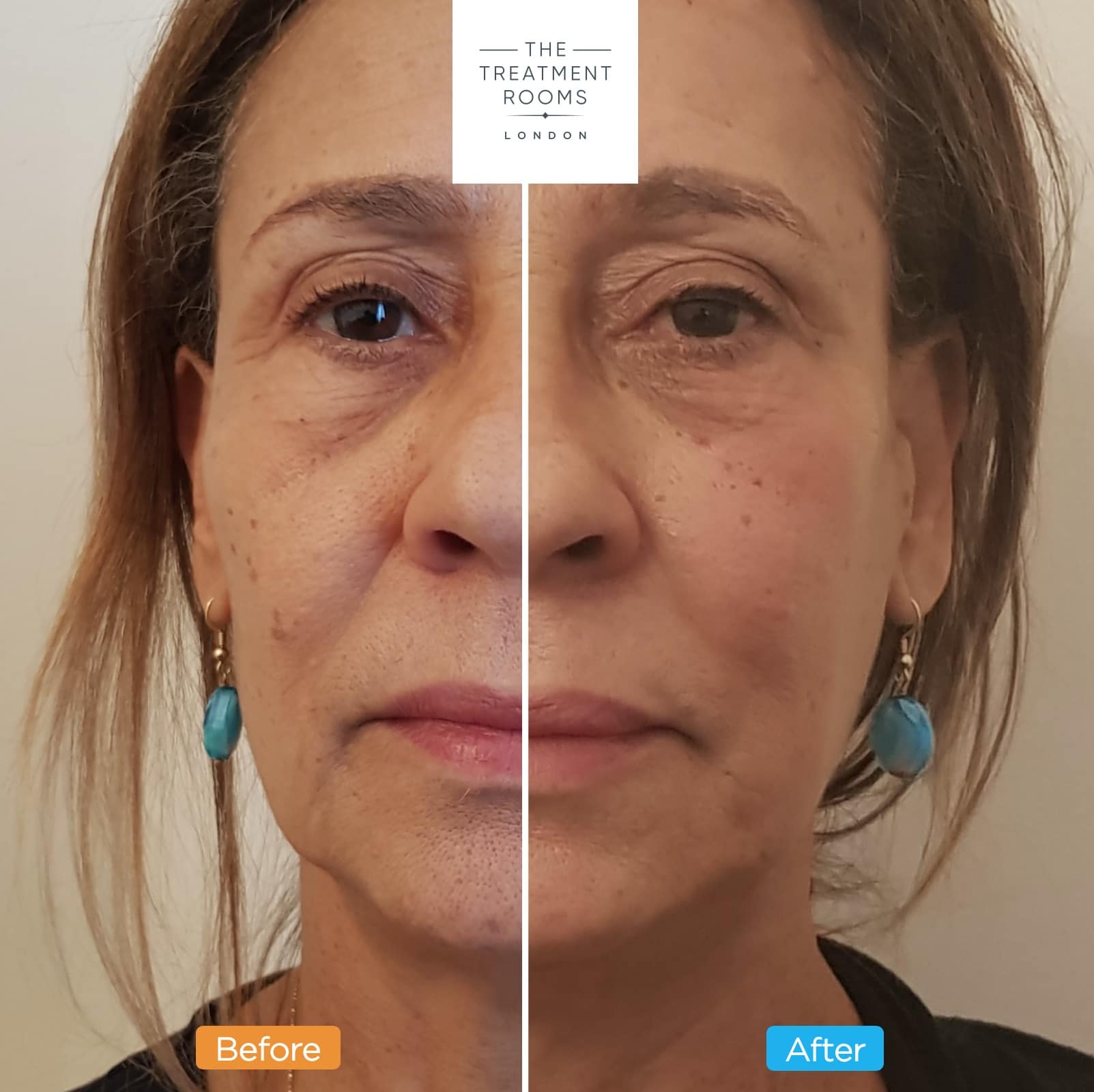 Cheek Filler and rejuvenation