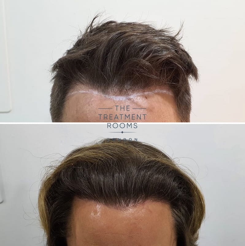 Corrective DHI hair transplant surgery hairline before and after