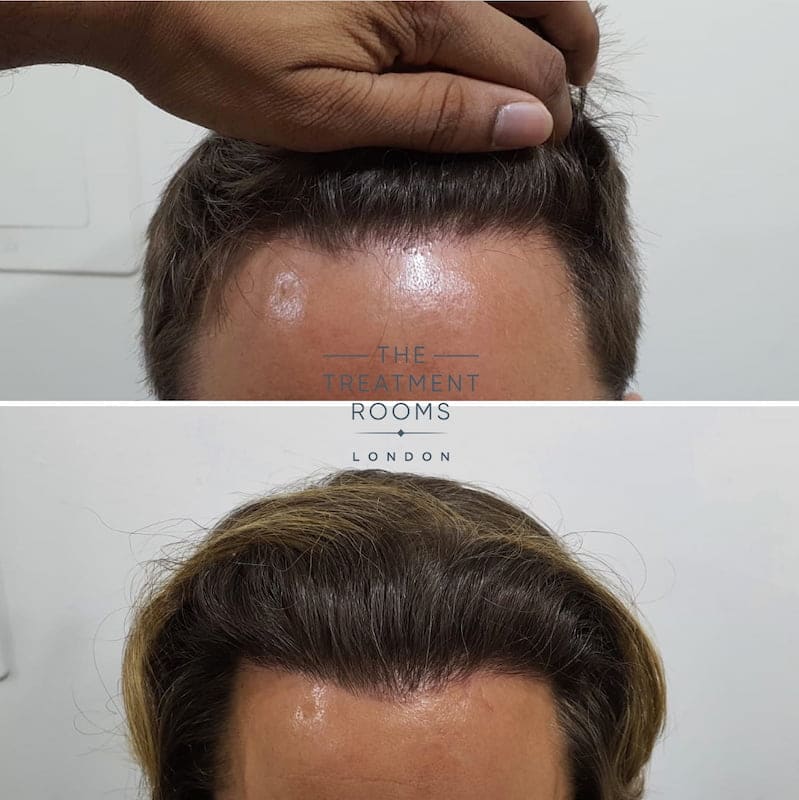 Corrective FUE hair transplant surgery hairline before and after
