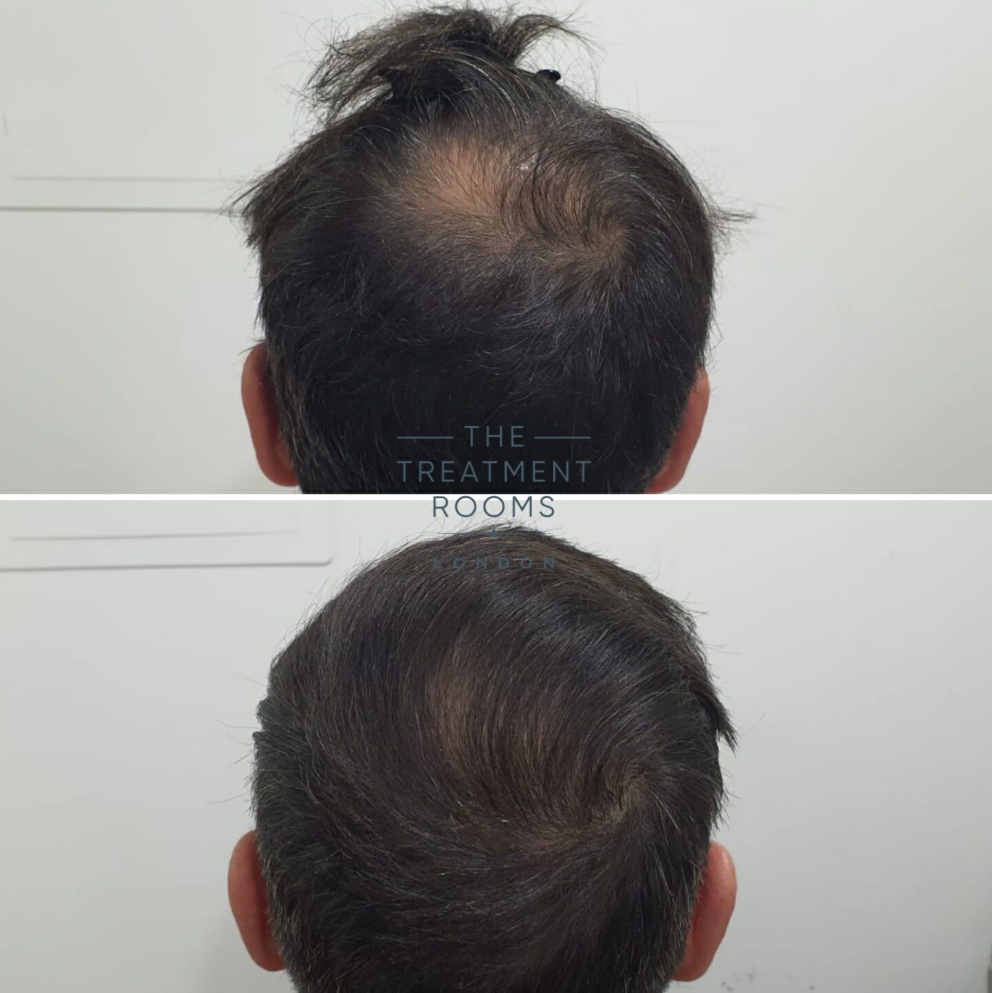 Crown Hair Transplant Result