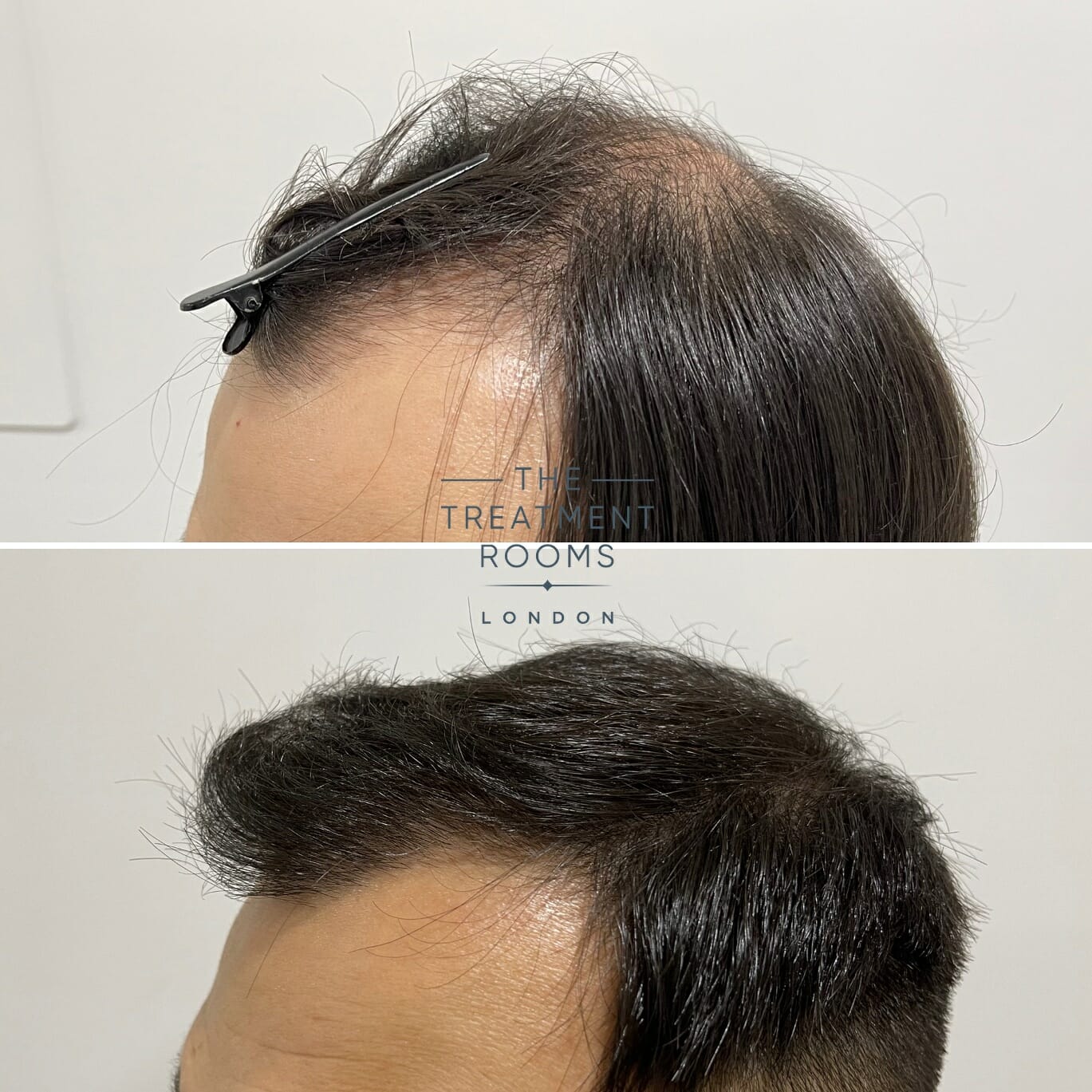 Crown and hairline hair transplant