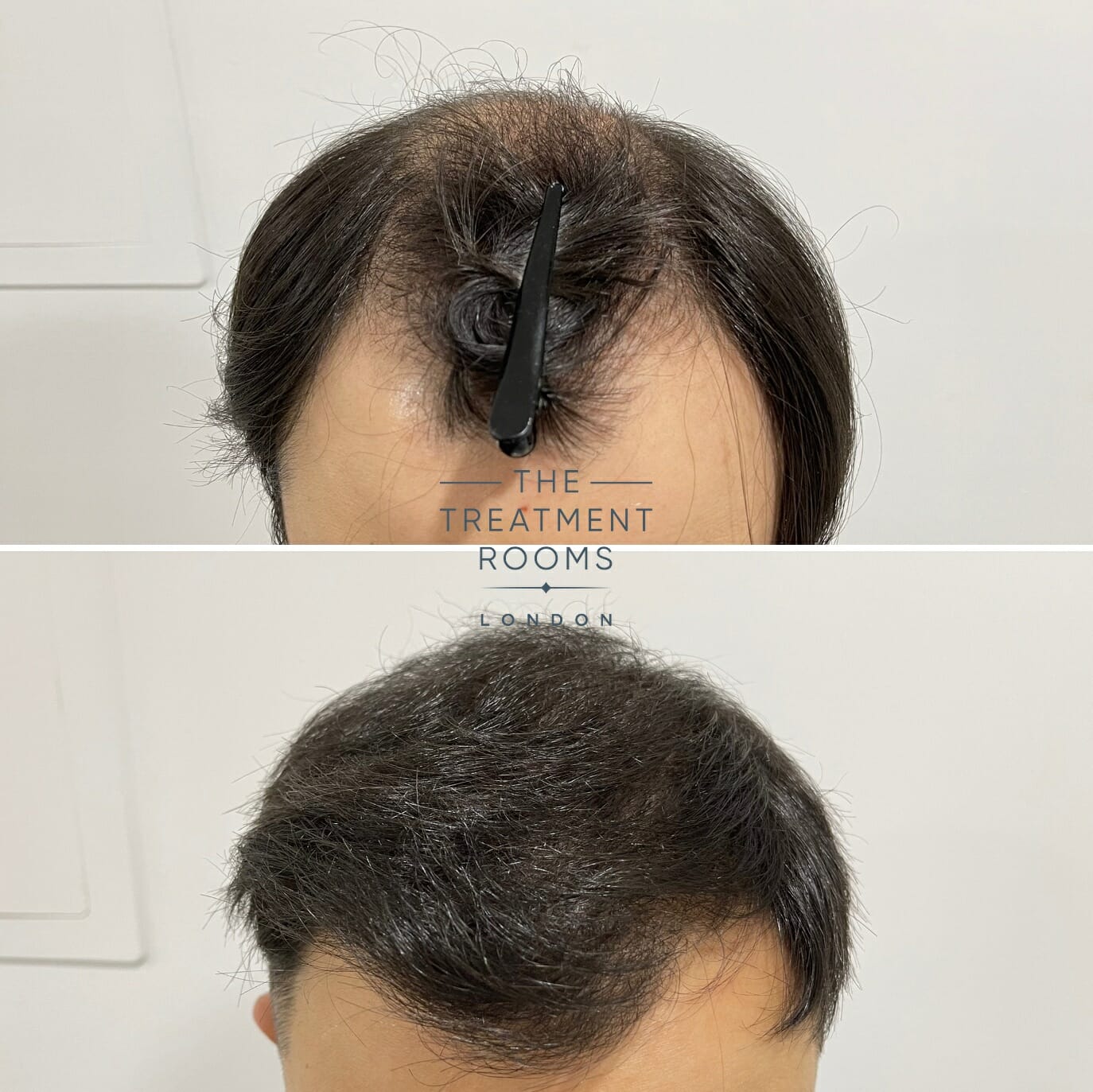 Crown and hairline hair transplant before and after