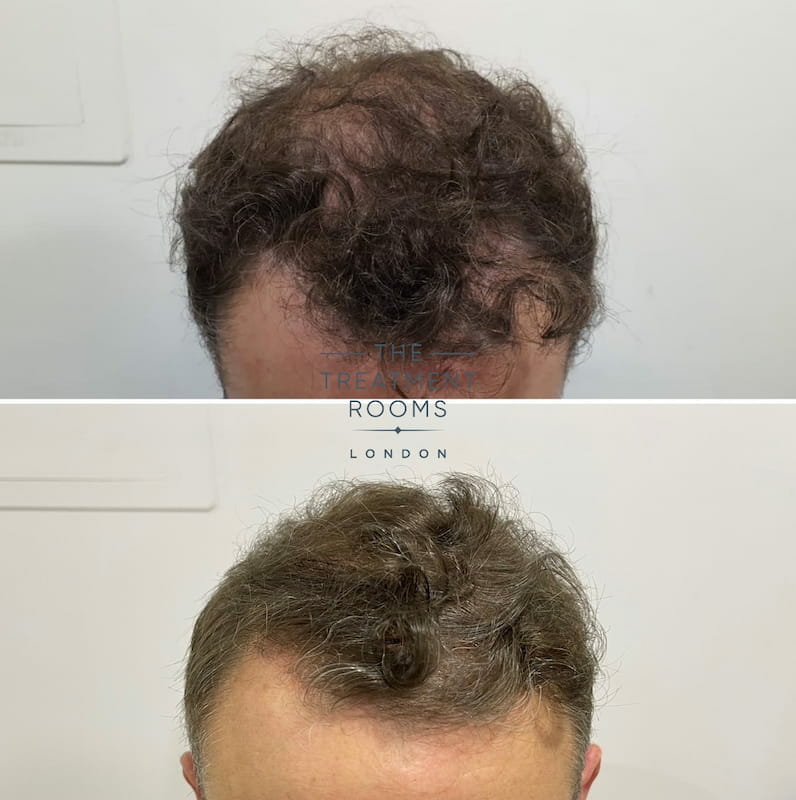 Crown and temple before and after hair transplant