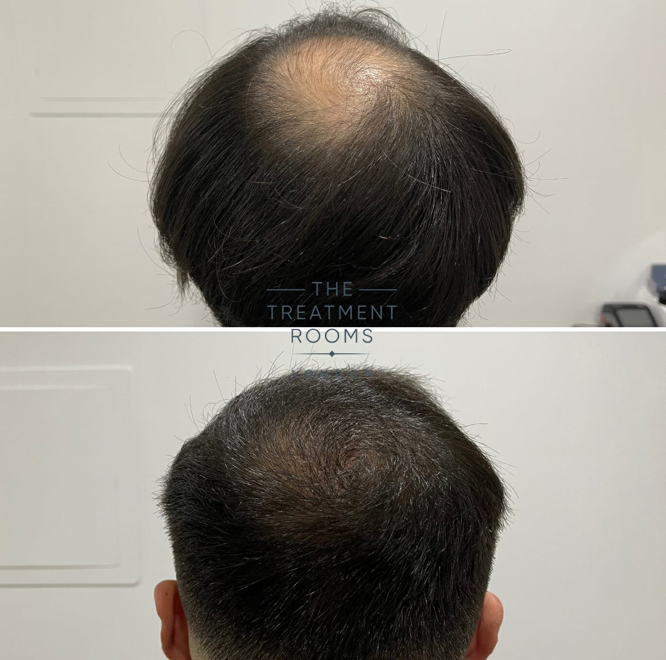 Crown hair transplant result