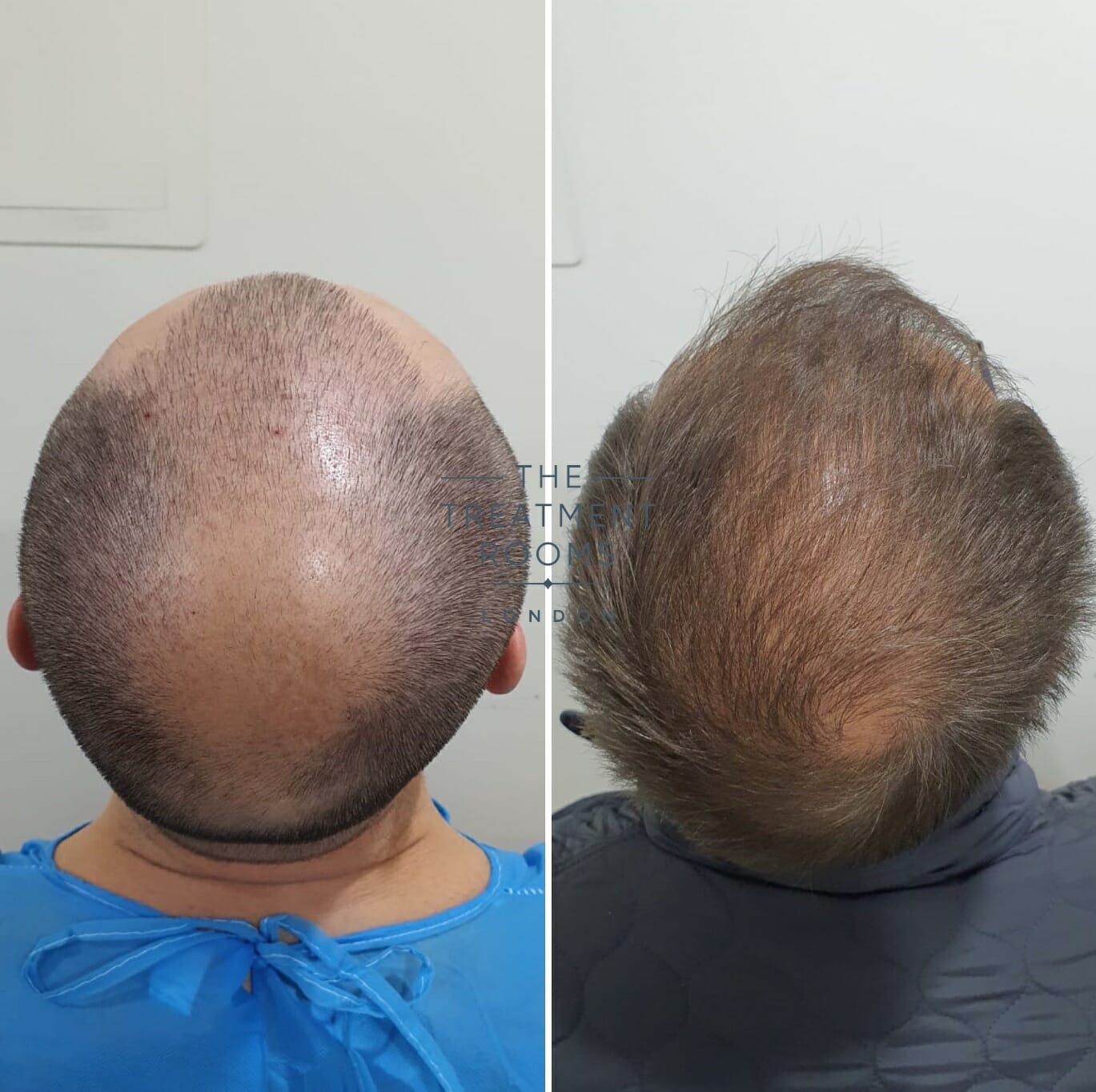 Crown hair transplant result 2000 grafts