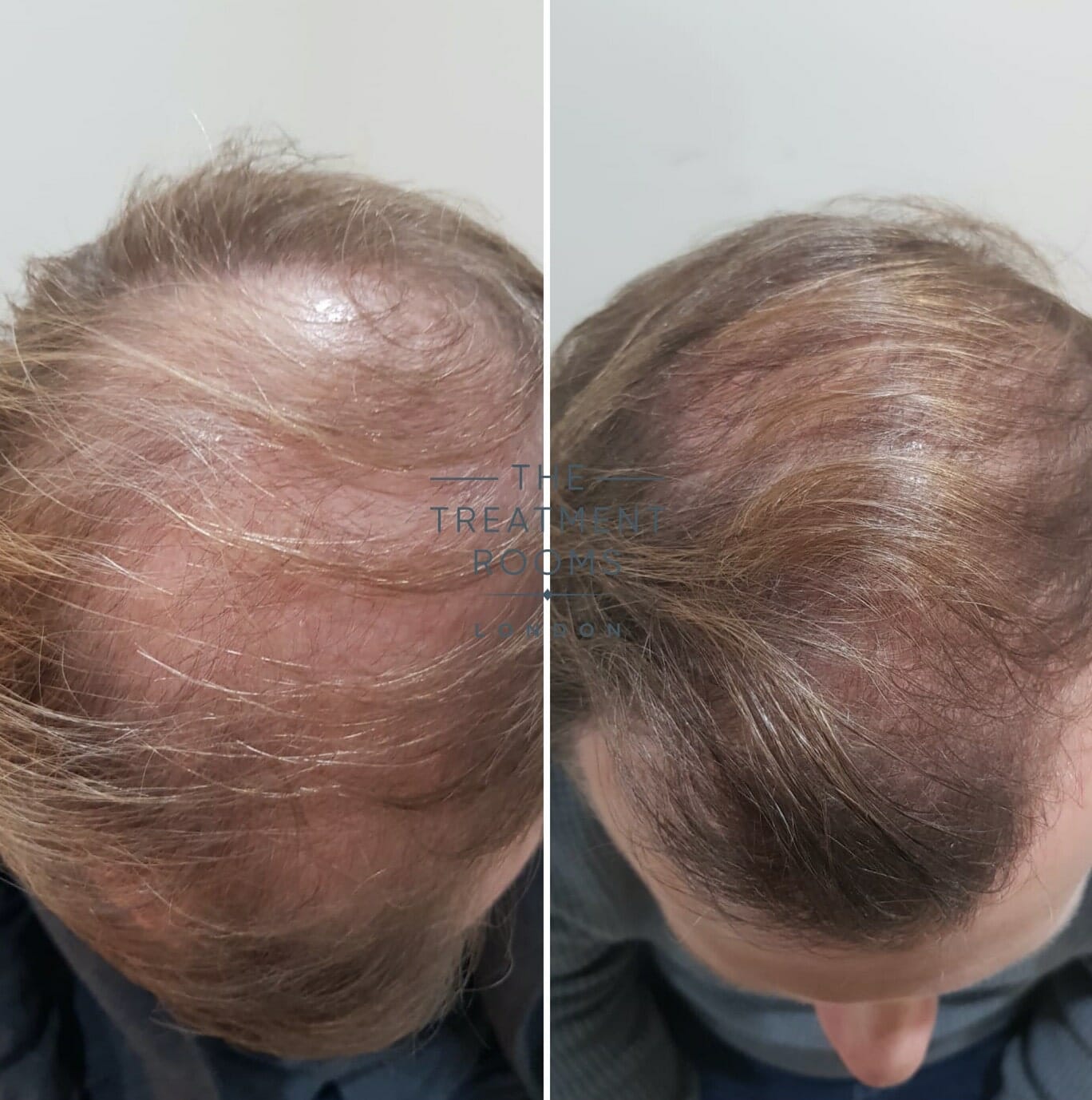 Crown hair transplant result london