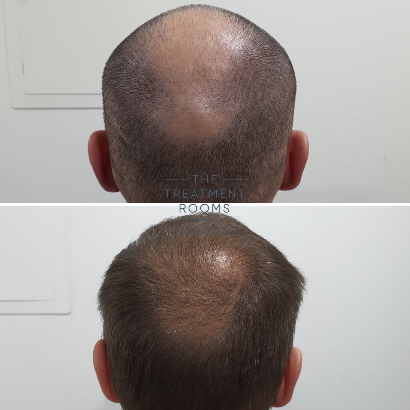 Crown hair transplant result Crown hair transplant result