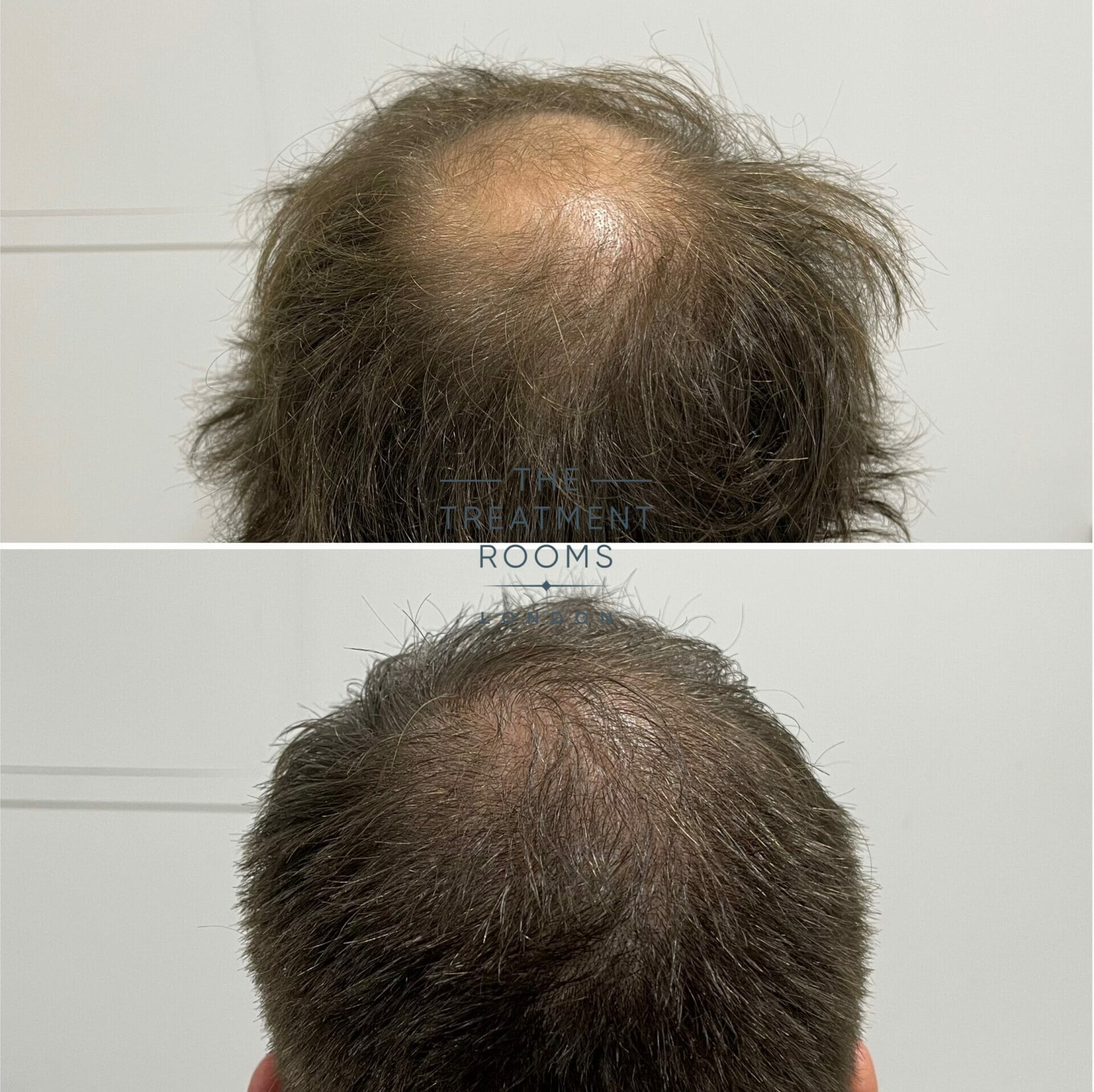 Crown transplant before and after 1762 grafts