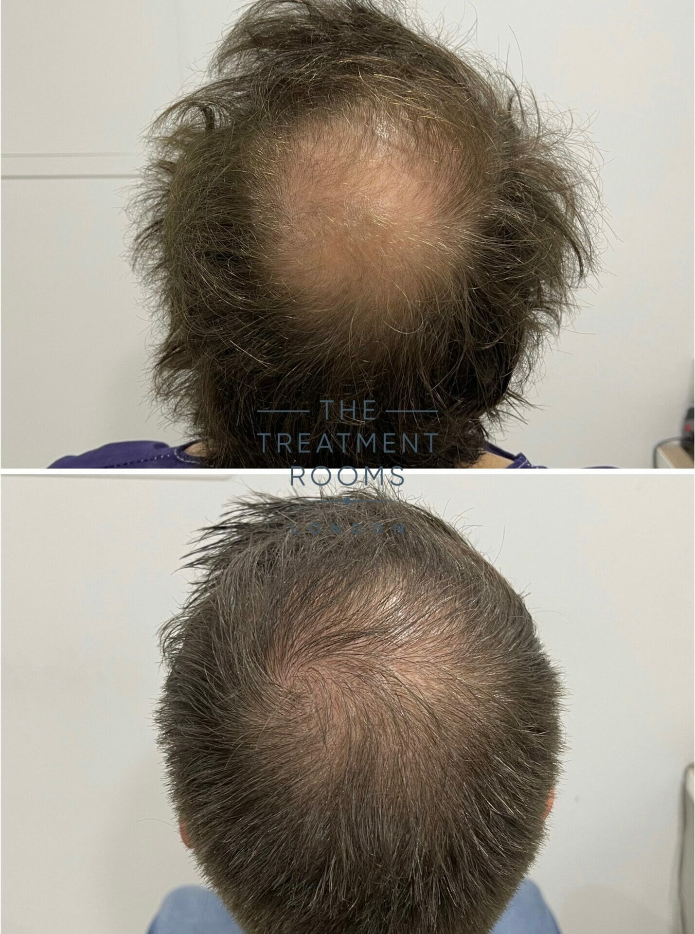 Crown transplant results 1762 grafts