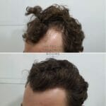 Curly hair FUE hair transplant 1243 grafts result