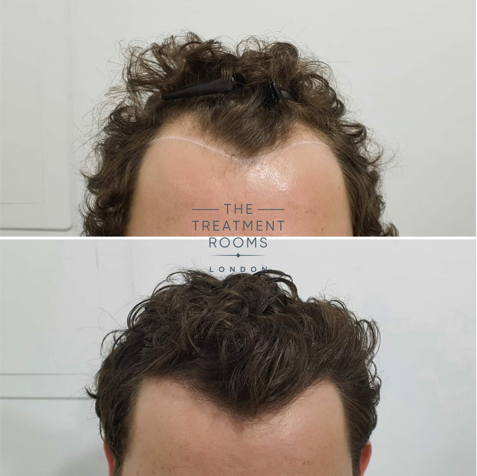 Curly hair FUE hair transplant 1243 graftsLondon