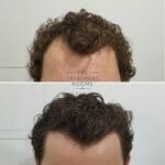 Curly hair FUE hair transplant before and after 1243 grafts