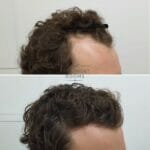 Curly hair transplant London 1243 grafts