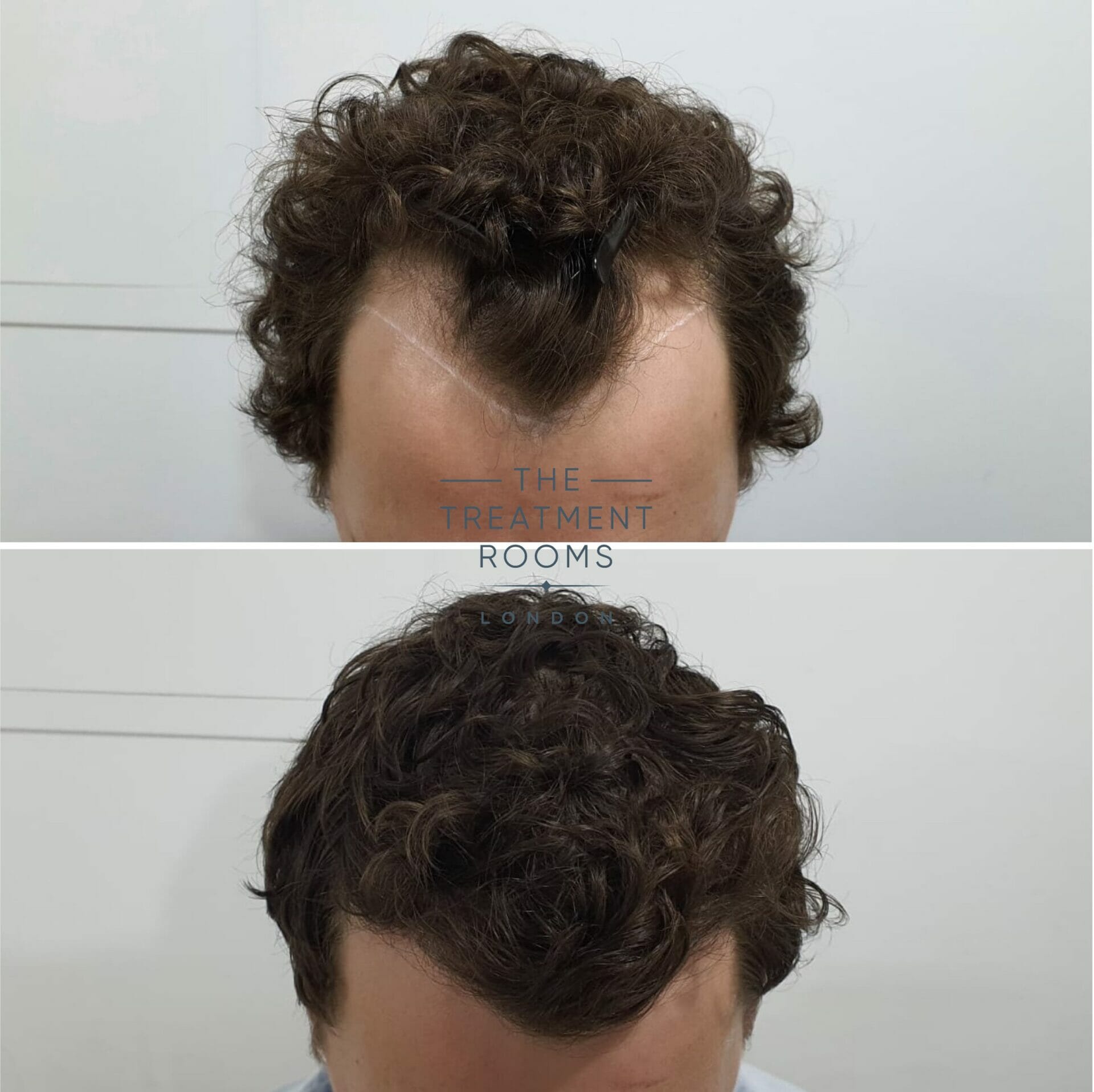 Curly hairline FUE hair transplant 1243 grafts