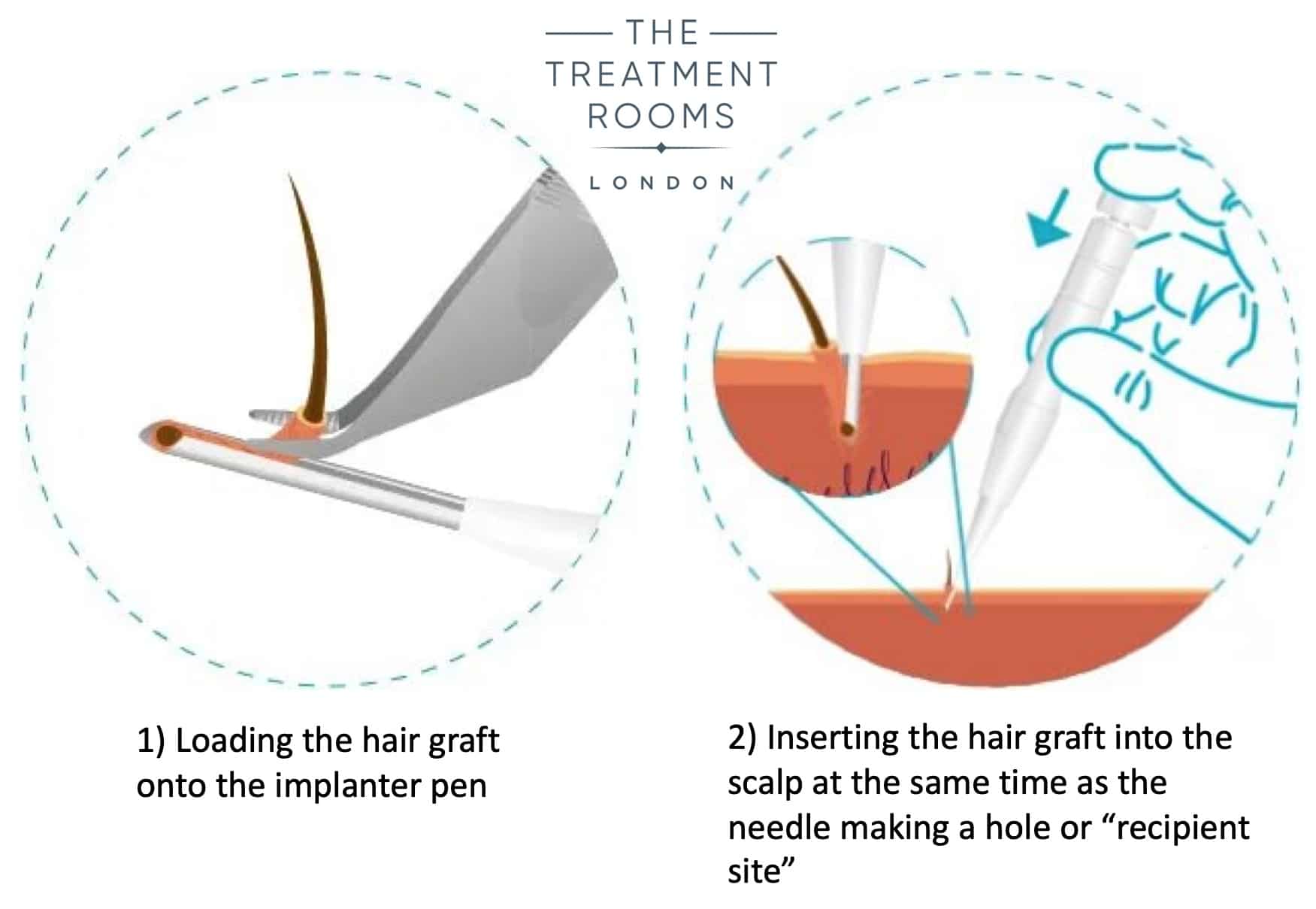 DHI implanter pen hair transplant information graphic