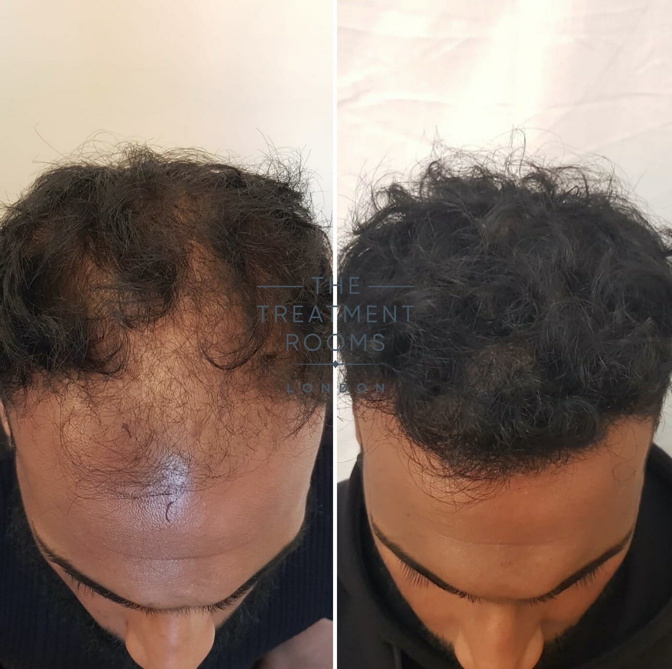 DHI implanter pen hair transplant result