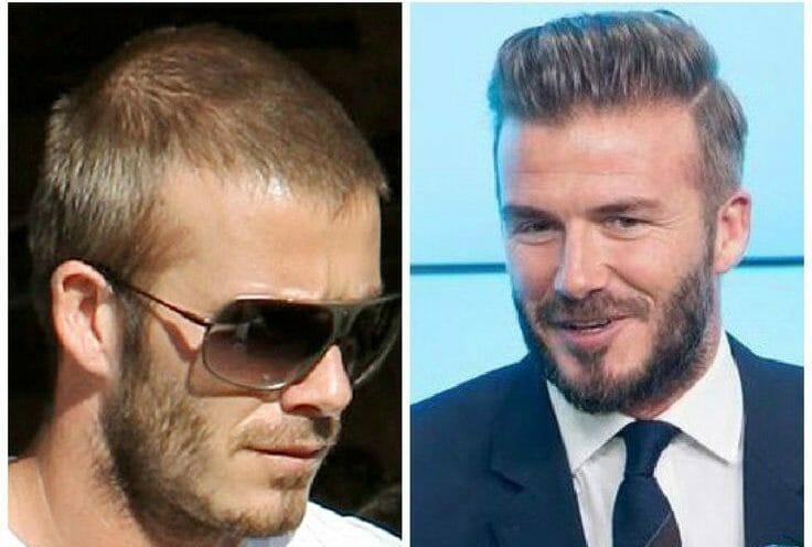 Analysing Celebrity Hair Transplants Before And After Surgery