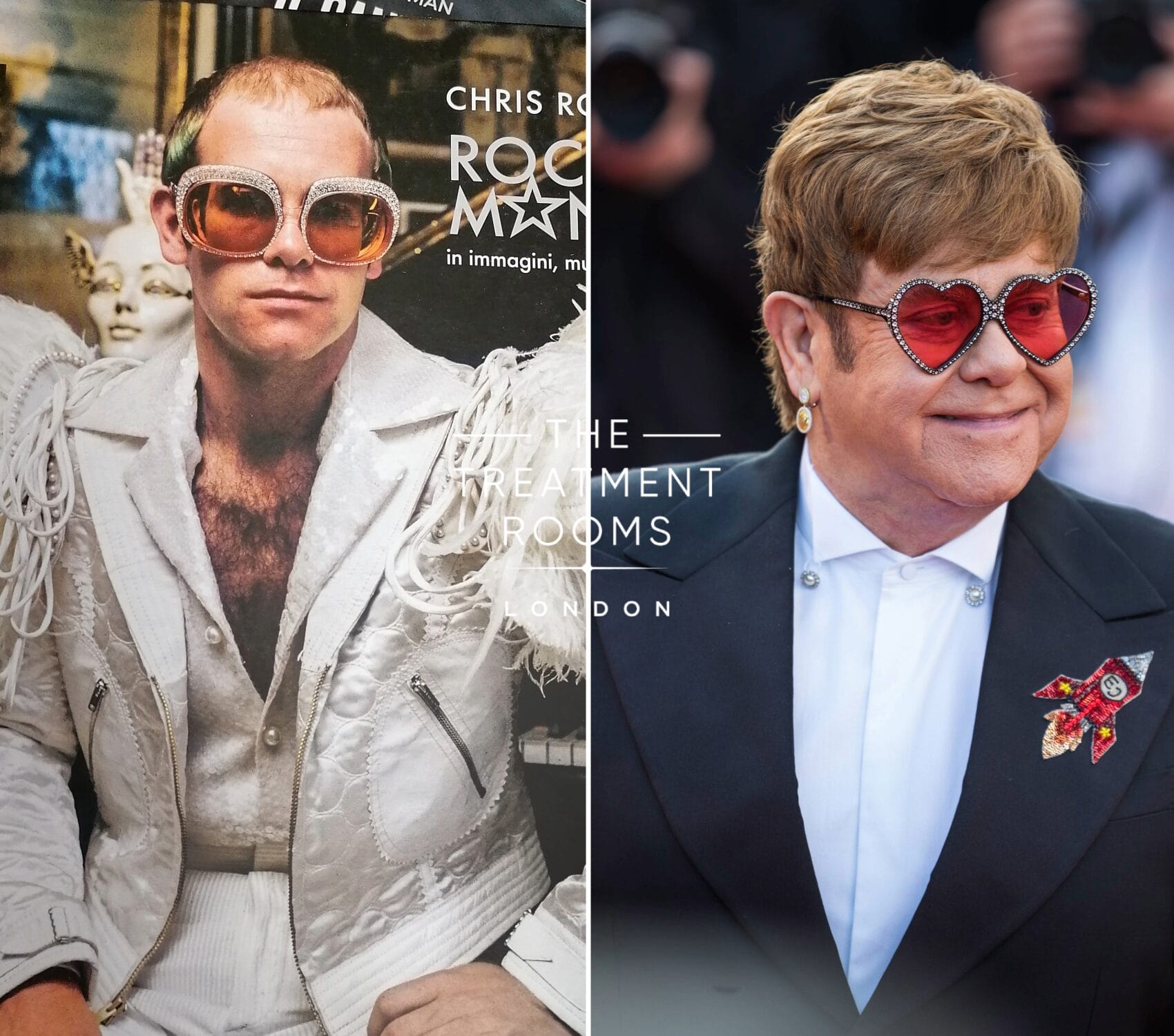 Elton John and His Hair Transplant Journey Treatment Rooms London