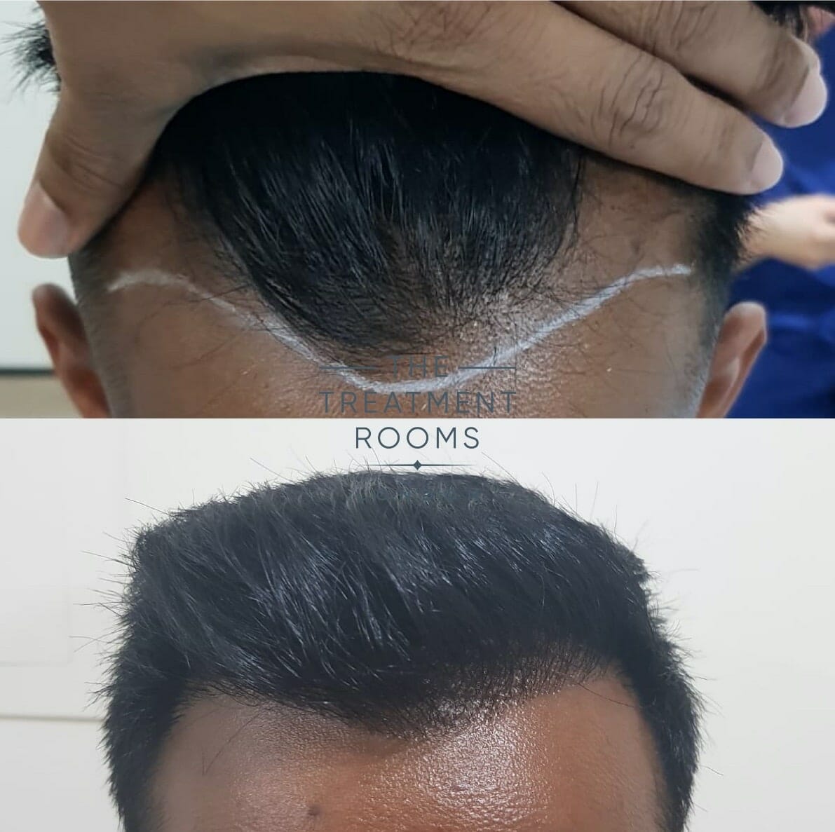 hairline hair transplant result