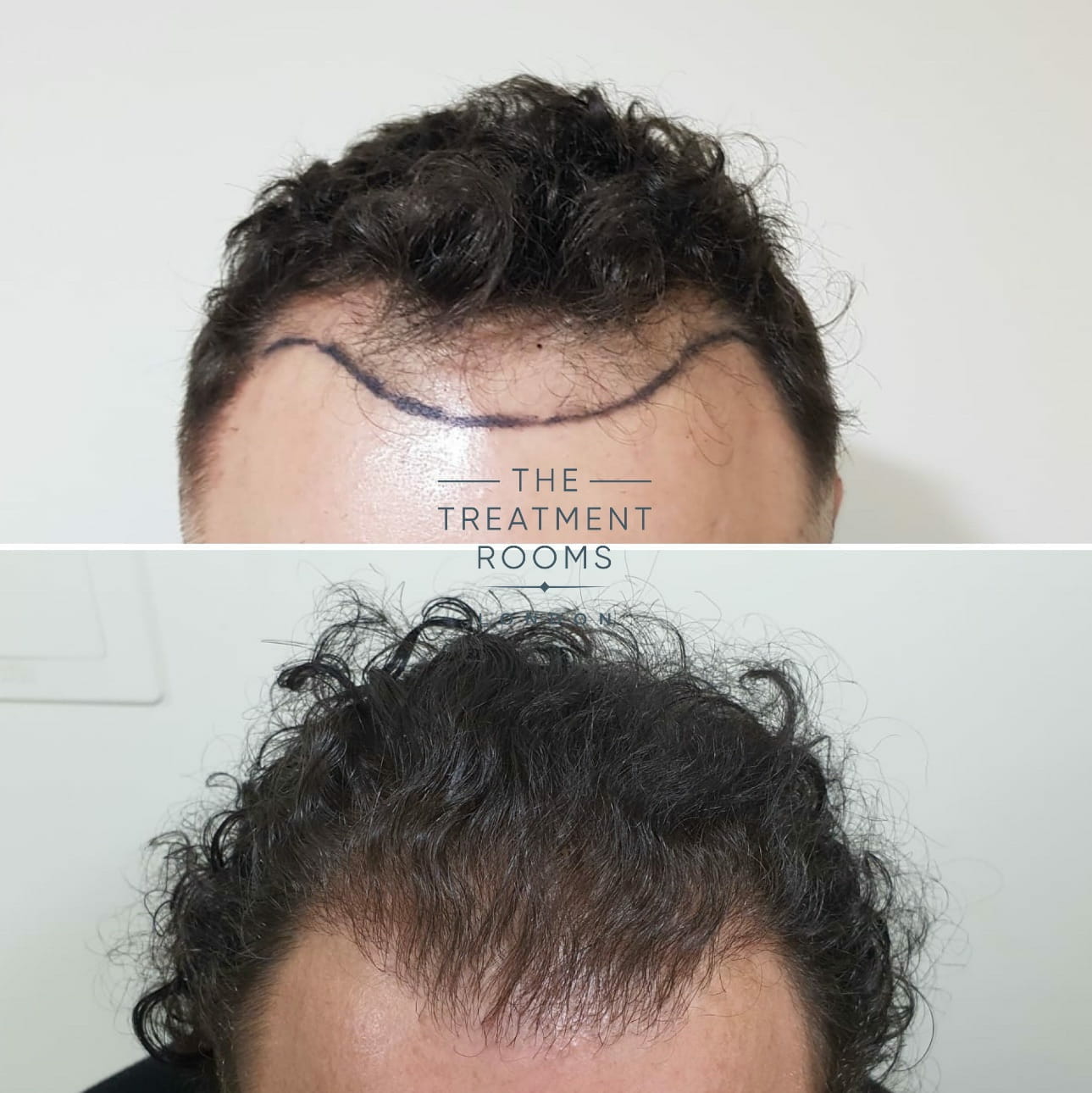FUE Hair Transplant Hairline Front Wavy Hair