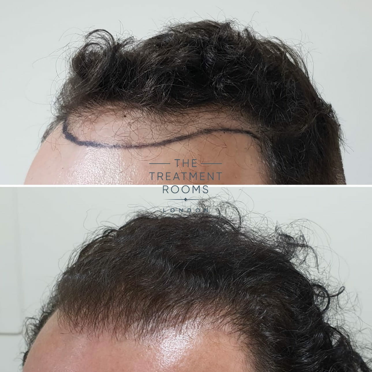 FUE Hair Transplant Left temple Wavy Hair