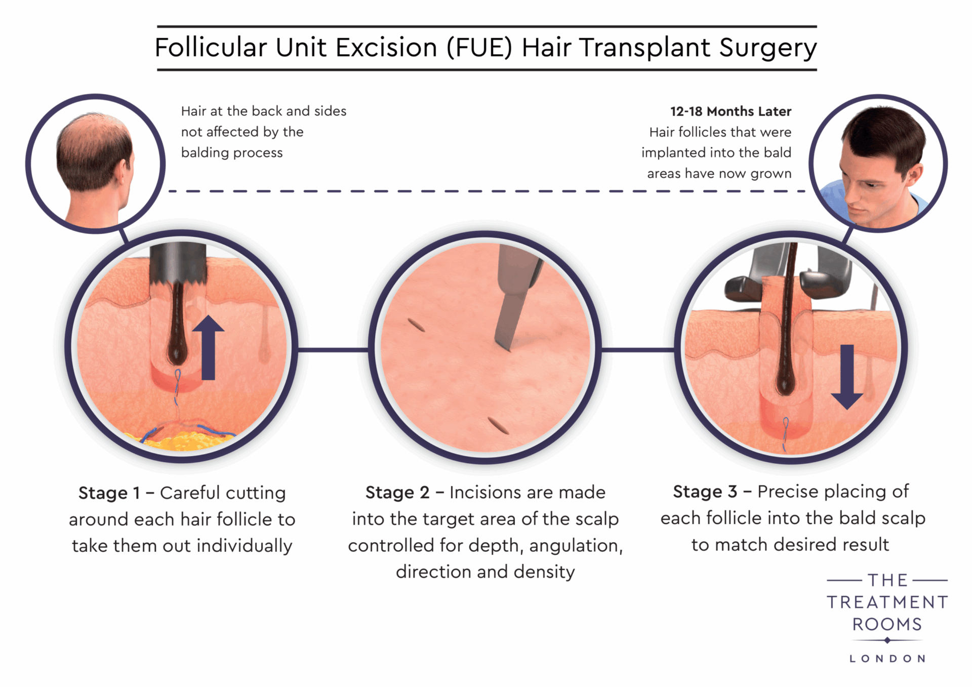 FUE Hair Transplant Surgery Diagram