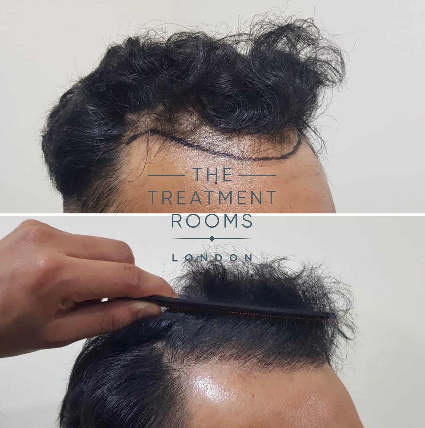 FUE Hair Transplant temple and front