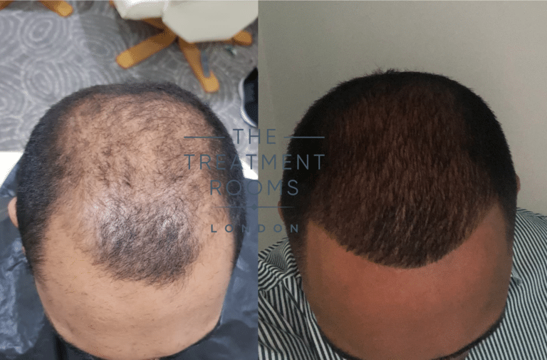 Before After Fue Hair Transplant Hair Transplant Specialists