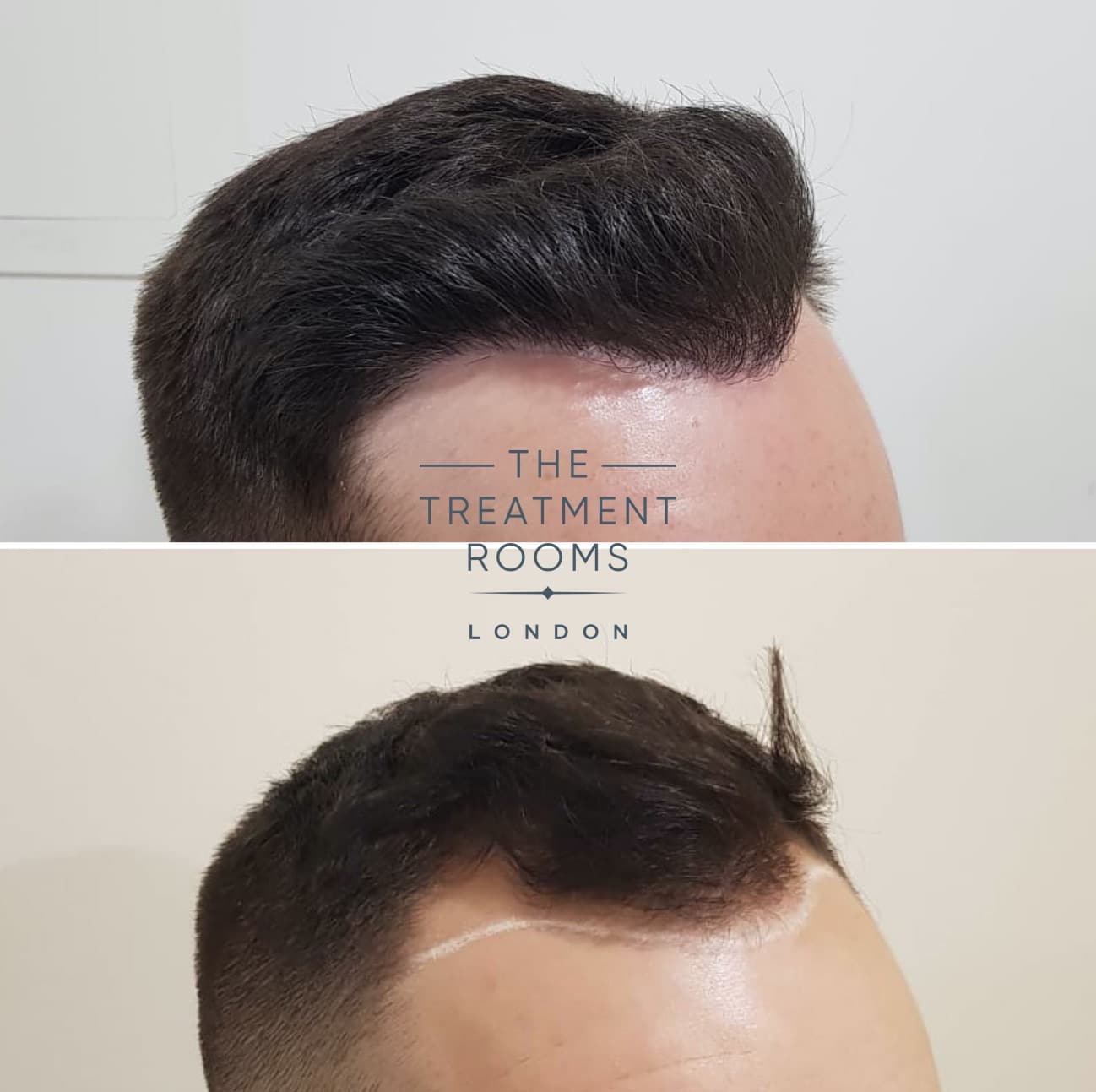 FUE Hair transplant scars