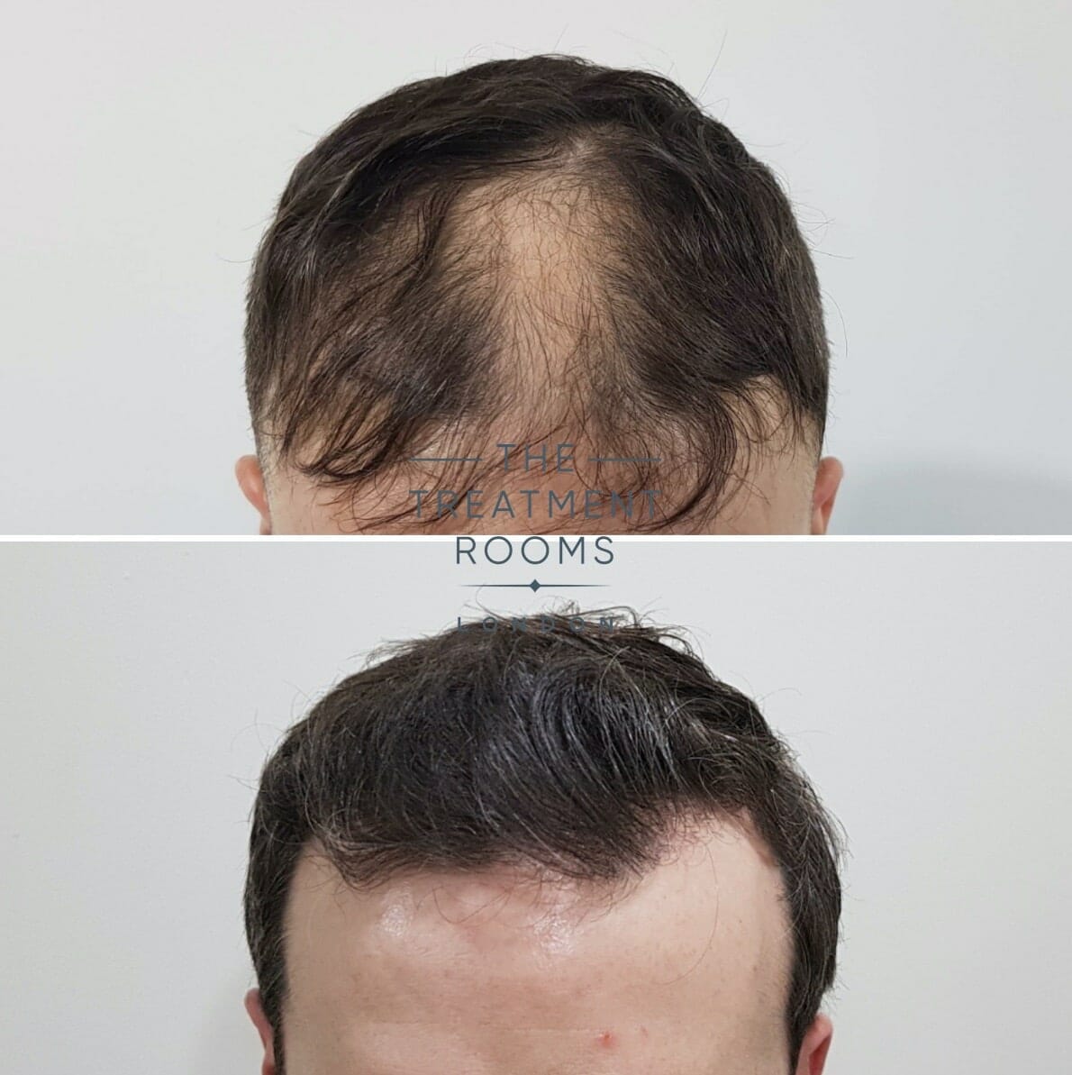 FUE hair transplant London result