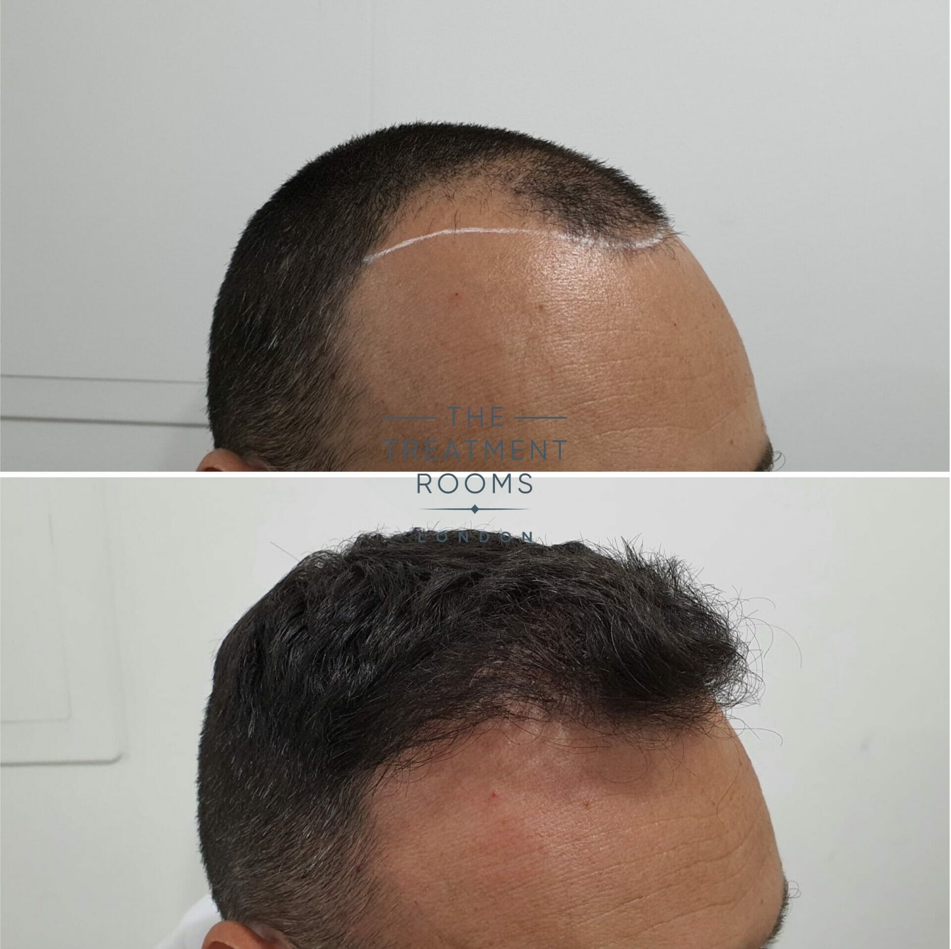 FUE hair transplant before and after 1498 grafts