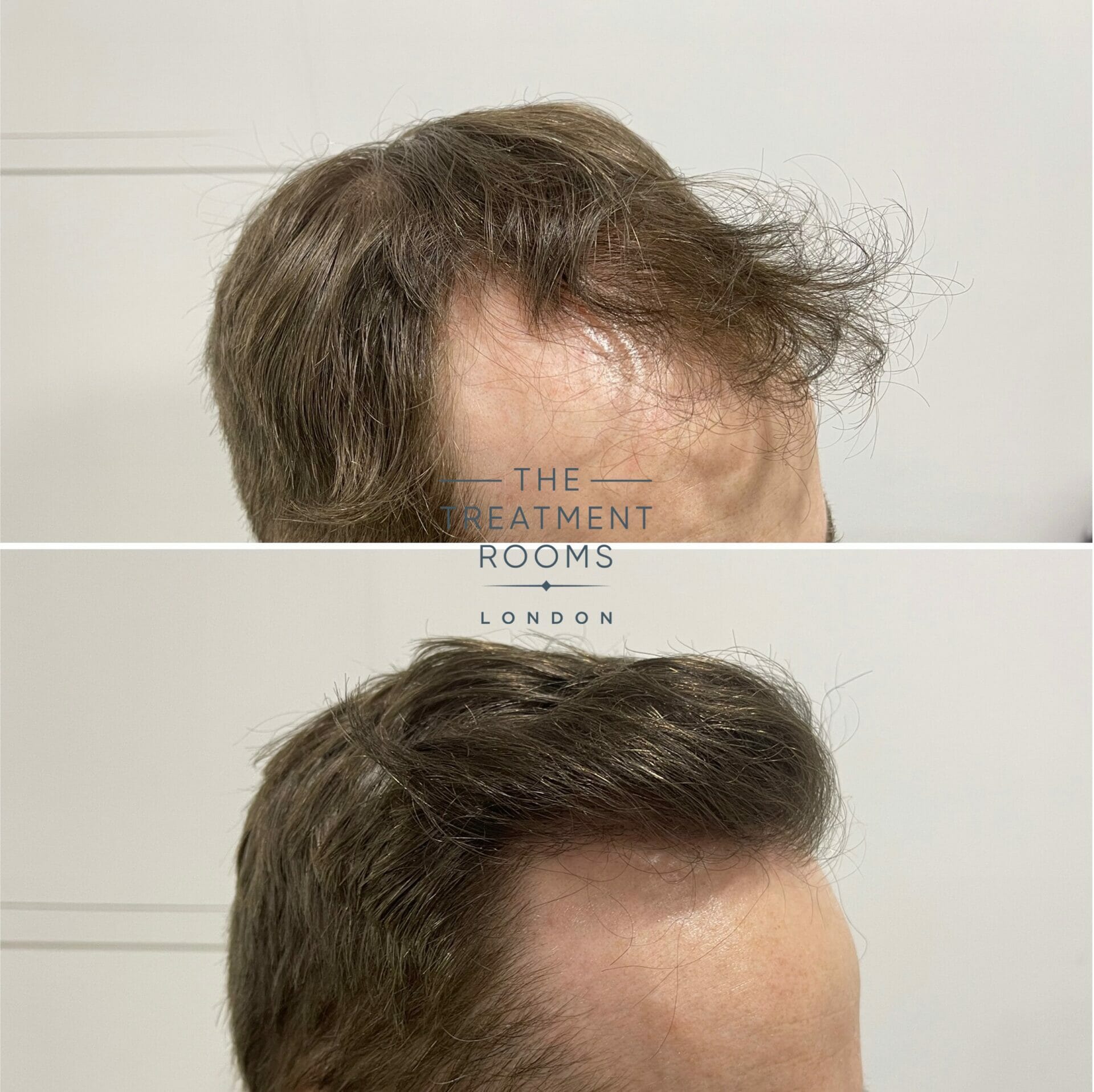 FUE hair transplant before and after close up