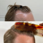 FUE hair transplant before and after with comb