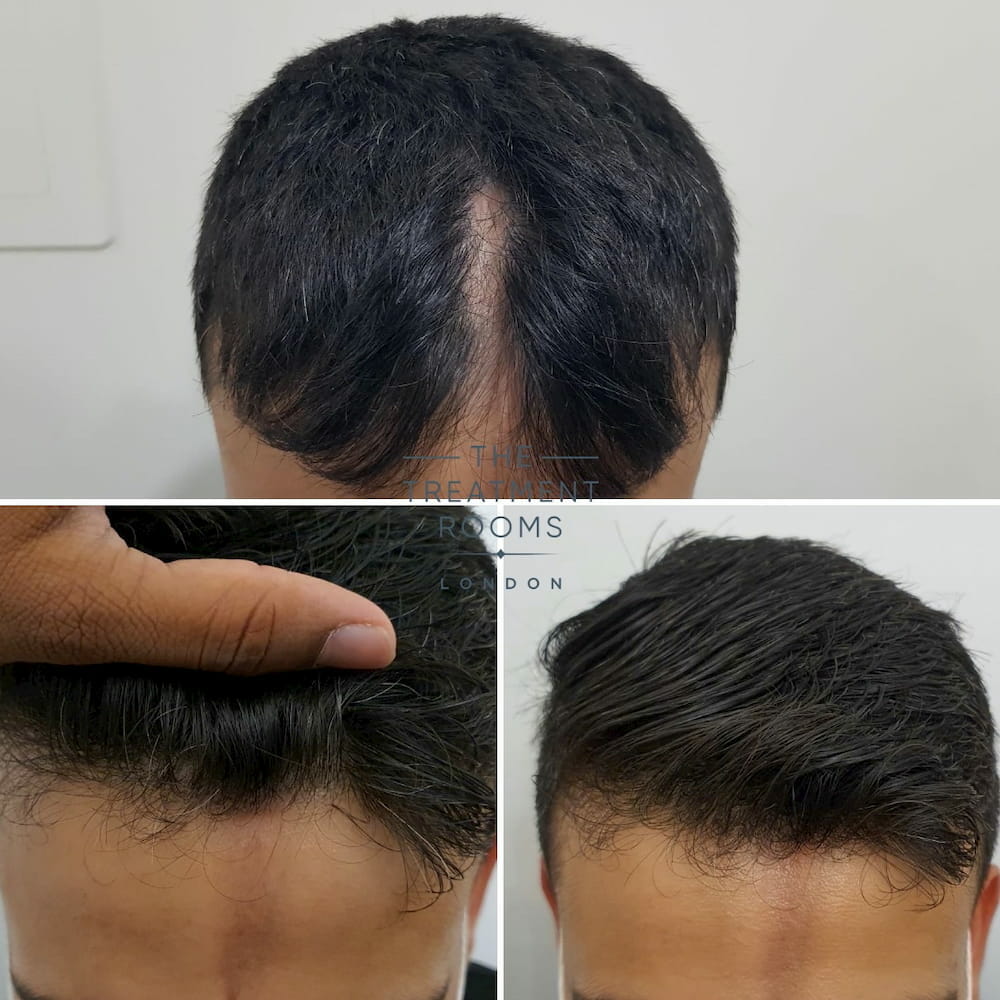 FUE hair transplant for linear scleroderma